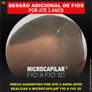 <b>Sessão Adicional de Fios 3D – Desconto até 2 Anos Após a Técnica Fio a Fio 3D</b>