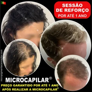 Sessão de Reforço da Microcapilar®: Efeito Densidade ou Cabelo Rapado – num prazo máximo de 1 ano.