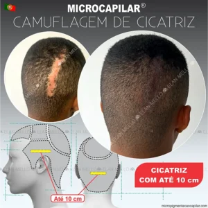 Microcapilar® em Cicatrizes com até 10 cm