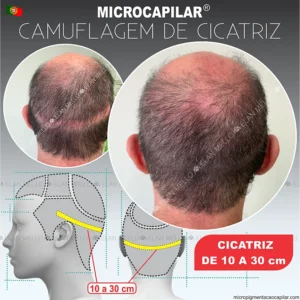 Microcapilar® em Cicatrizes de 10 cm até 30 cm