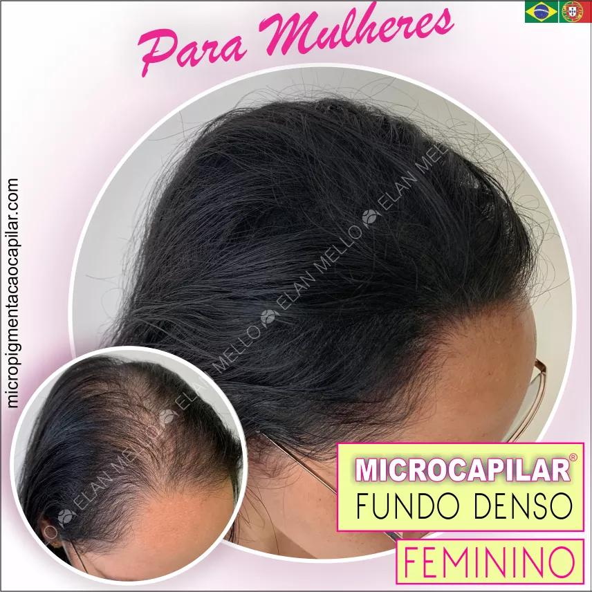 Antes e depois da micropigmentação capilar feminina para tratamento da rarefação de calvície genética na cabeça de uma mulher