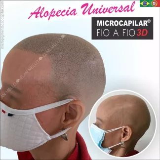 MICROCAPILAR® FIO A FIO 3D EM ALOPECIA UNIVERSAL, AREATA OU TOTAL
