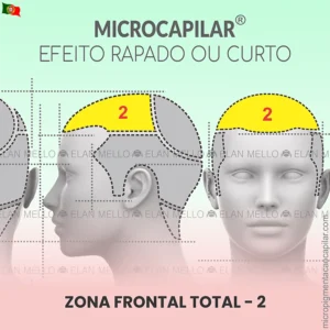 Zona Frontal Total - n.º 2 - Microcapilar® Efeito Cabelo Rapado ou Curto