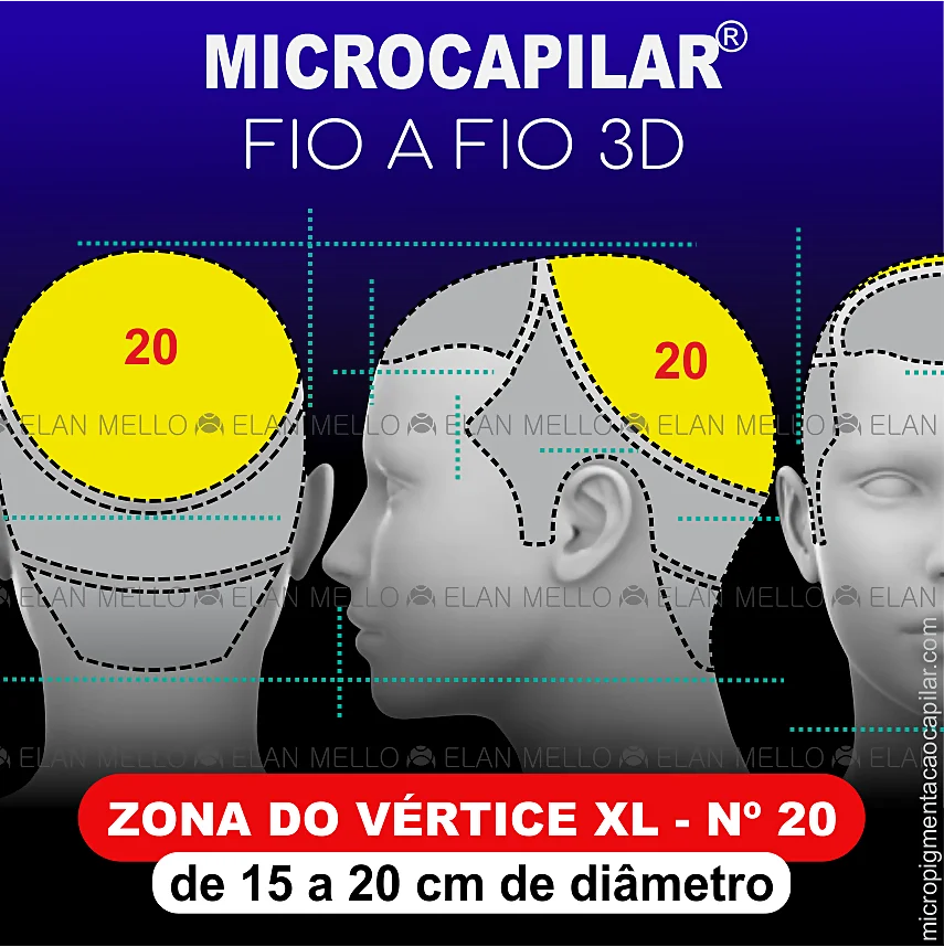 Zona do Vértice de 15 a 20 cm de diâmetro - n.º 20 – Microcapilar® Fio a Fio 3D