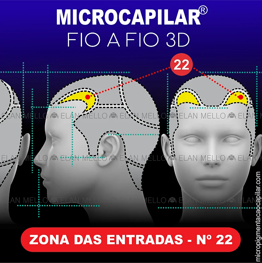 Zona das Entradas – n.º 22 – Microcapilar® Fio a Fio 3D
