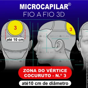 Zona do Vértice com até 10 cm de diâmetro - n.º 3 – Microcapilar® Fio a Fio 3D