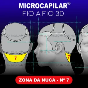 Zona da Nuca n.º 7 - Microcapilar® Fio a Fio 3D